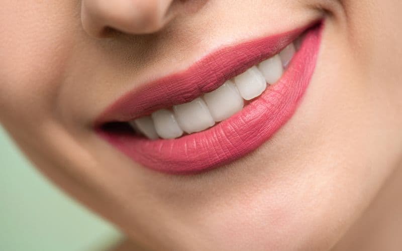 Full Porcelain Veneers — before treatment